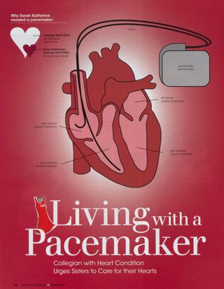 Living With a Pacemaker